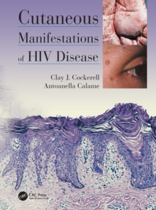 Cutaneous Manifestations of HIV Disease, EPUB eBook Cutaneous Manifestations of HIV Disease, EPUB eBook